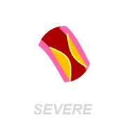 severe_attack